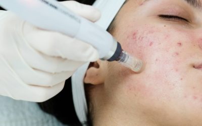 Cryosurgery Treatment