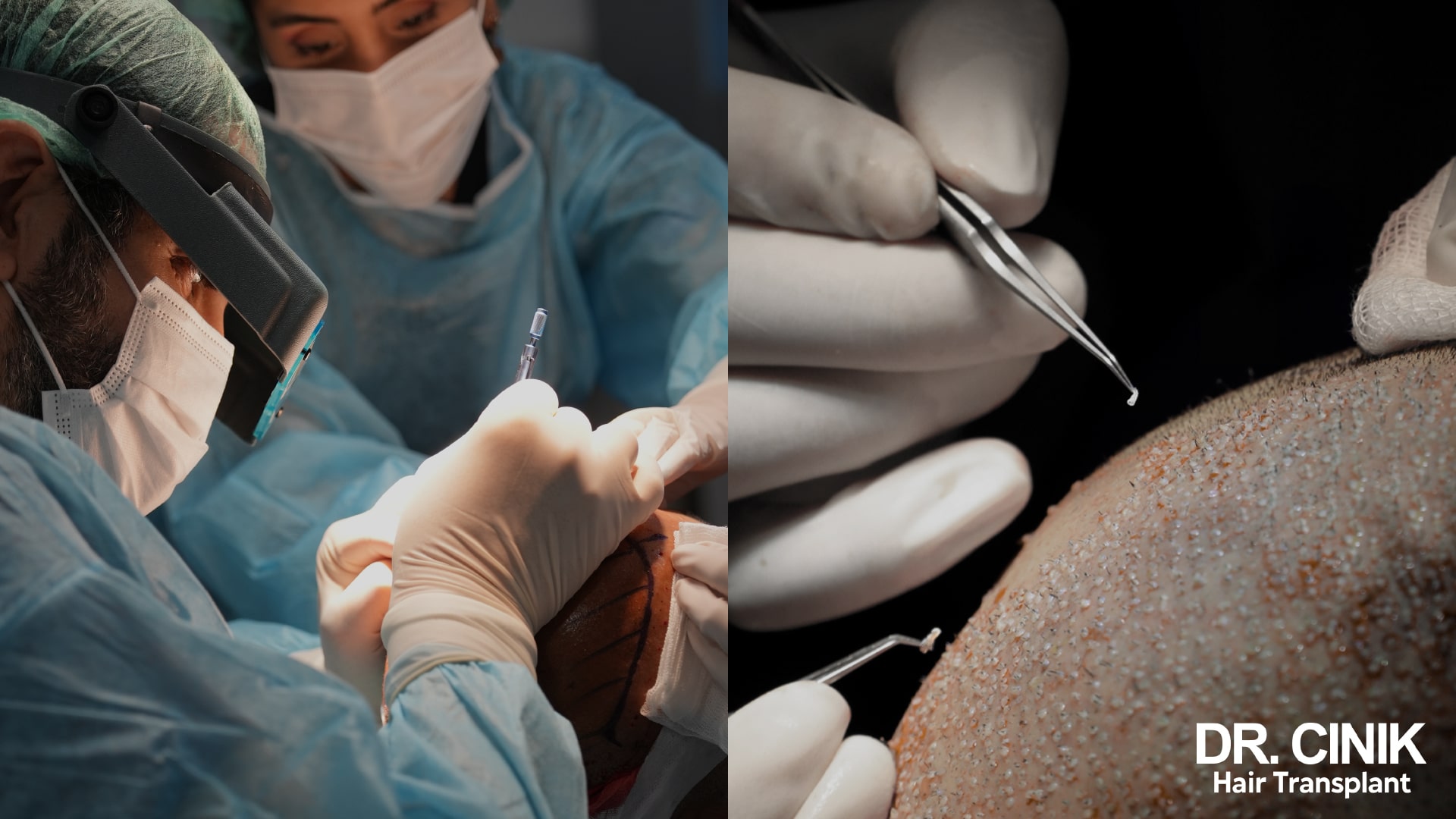 DHI Hair Implantation